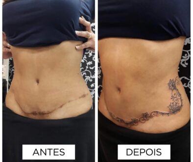 Fer Mello - Cobertura de cicatriz de abdominoplastia