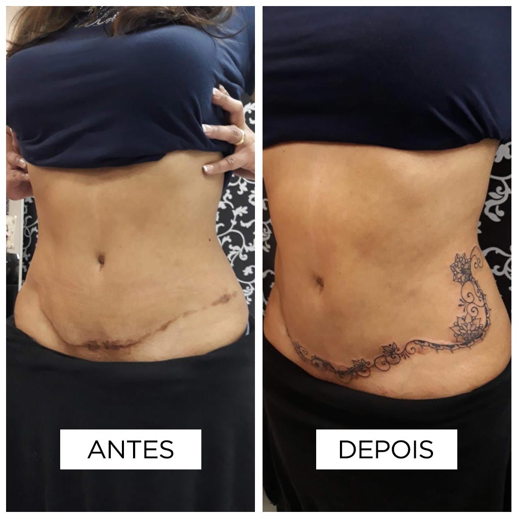 Fer Mello - Cobertura de cicatriz de abdominoplastia
