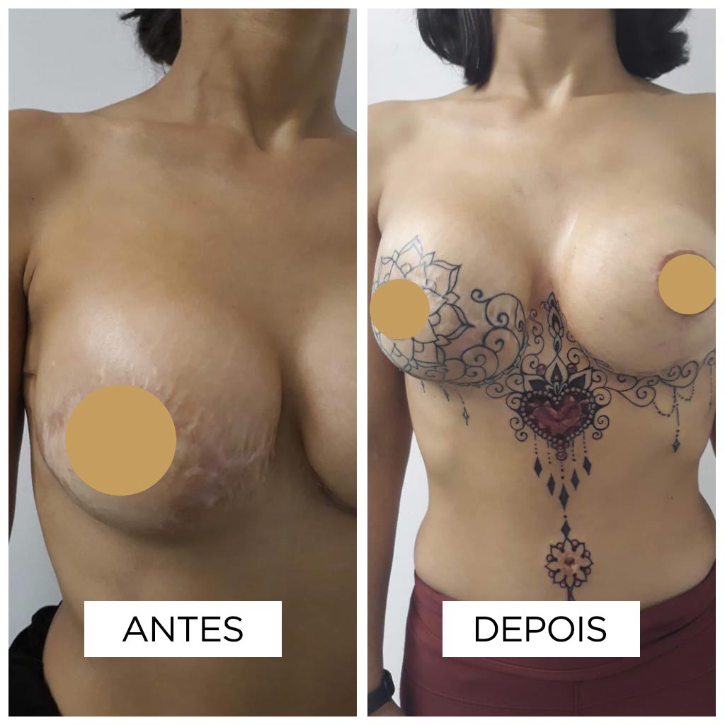 Fer Mello - Cobertura de cicatriz de mastectomia